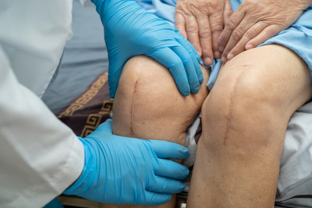 Primary Knee Replacement 5 asian senior or elderly old lady woman patient sho 2025 02 25 05 53 42 utc