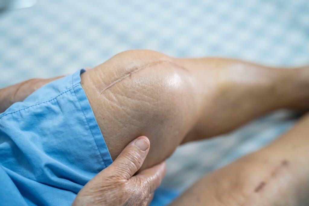 Revision Knee Replacement 3 asian senior or elderly old lady woman patient sho 2025 02 25 15 36 35 utc 1