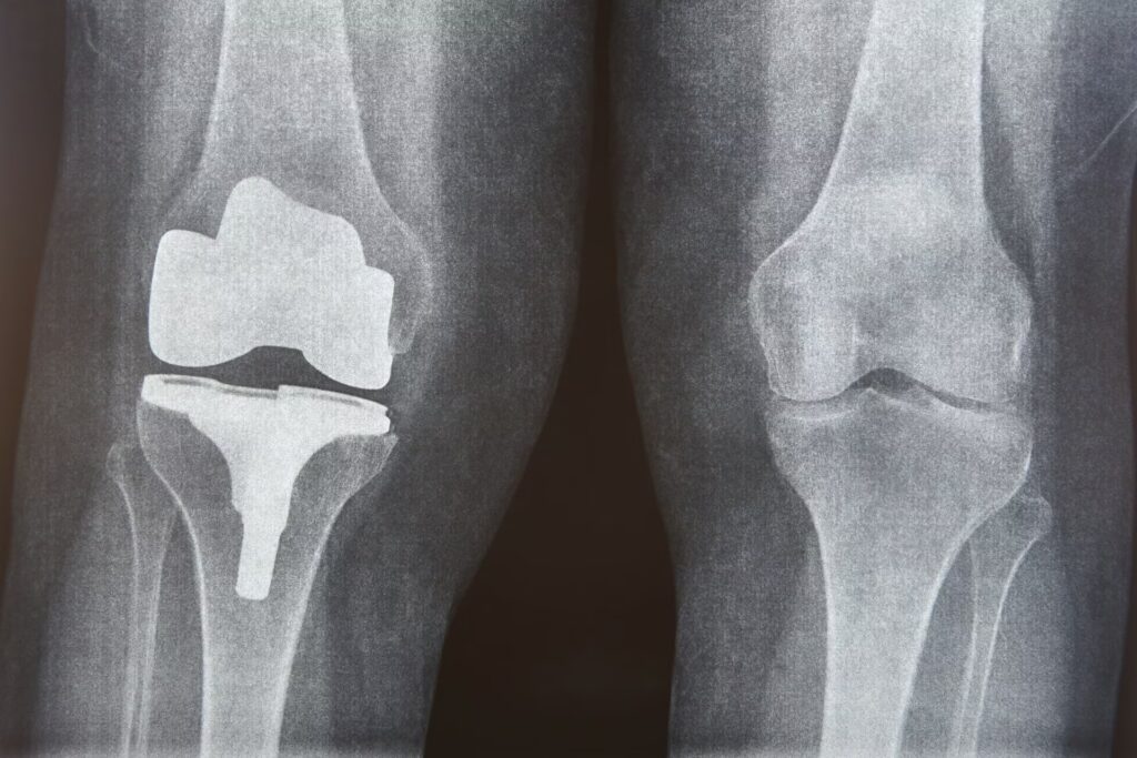 Robotic Assisted Joint Replacement 7 knee cap replacement xrays titanium implant oste 2025 01 28 01 22 05 utc 1